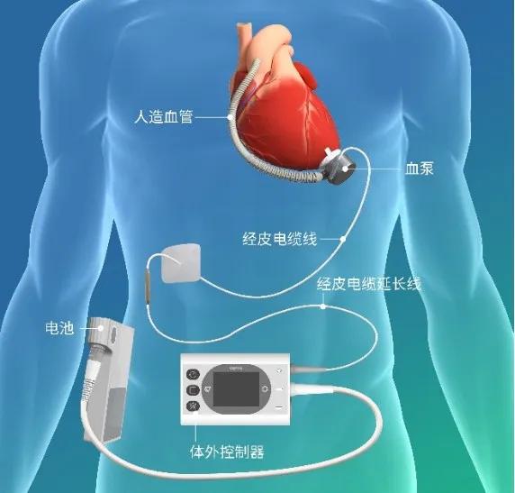 人工心脏纳入医保，全国四家医院开启试点！  第5张